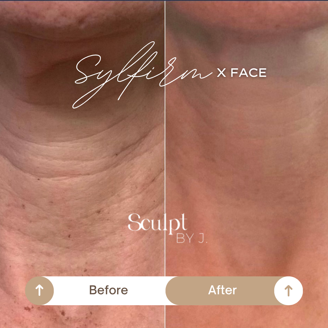 Thuzzle-Resurfacing_2